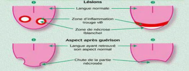 Lesion langue chenille processionnaire du pin